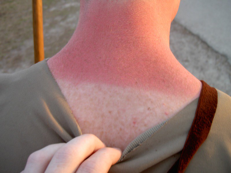 Got Sunburn? Here’s Some Hints and Tips